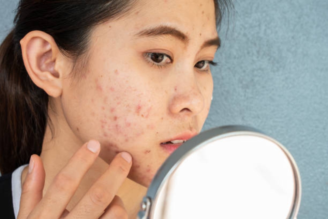 How can I prevent and treat acne 